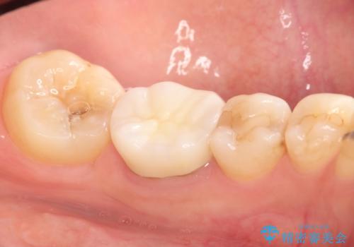 目立つ銀歯を白くしたい セラミック治療の治療後