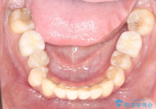 目立つ銀歯を白くしたい セラミック治療