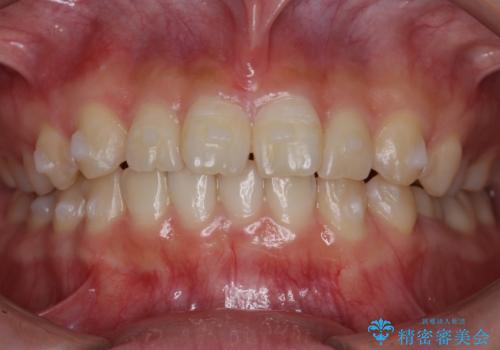 前歯のねじれ 乳歯を残して矯正治療の治療中