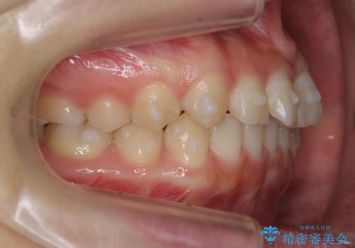 前歯のねじれ　乳歯を残して矯正治療の治療中