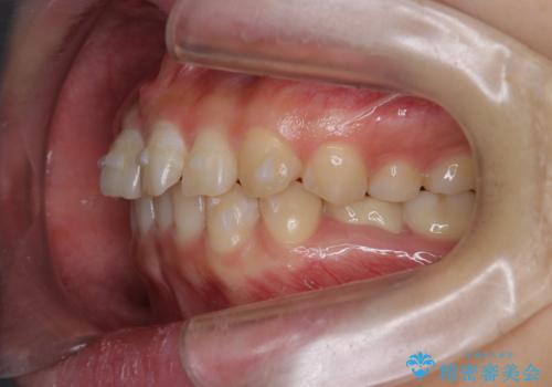 前歯のねじれ　乳歯を残して矯正治療の治療中