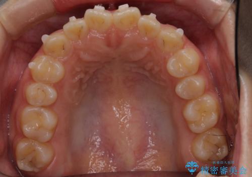 前歯のねじれ 乳歯を残して矯正治療の治療中
