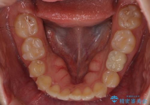 前歯のねじれ 乳歯を残して矯正治療の治療中