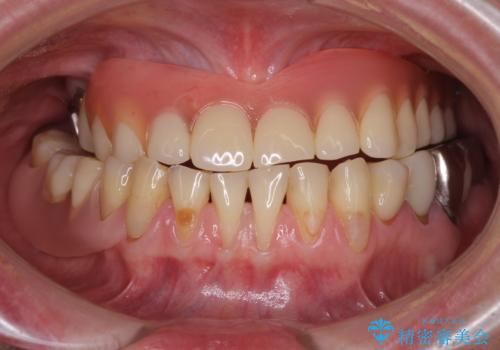 前歯の歯肉退縮 歯肉移植による根面被覆の治療前