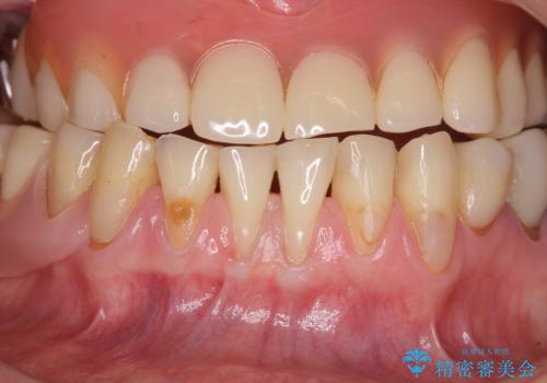 前歯の歯肉退縮 歯肉移植による根面被覆の治療前