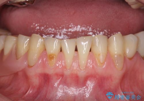 前歯の歯肉退縮 歯肉移植による根面被覆の症例 治療前