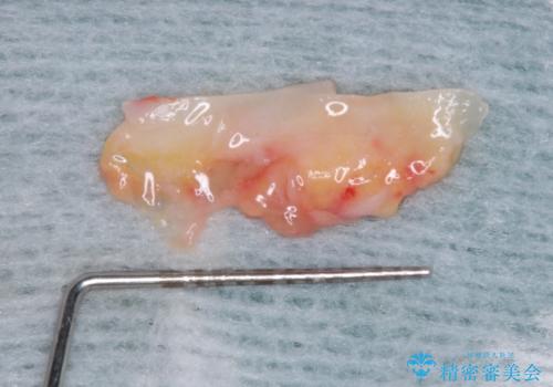 前歯の歯肉退縮 歯肉移植による根面被覆の治療前