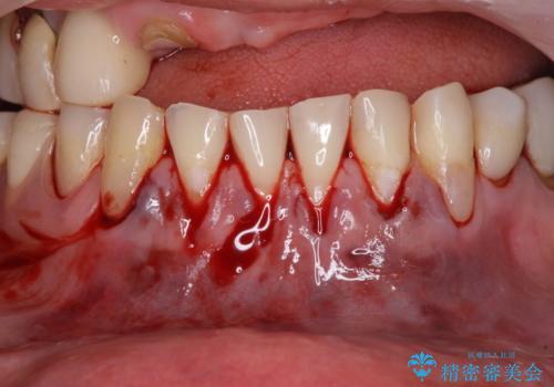 前歯の歯肉退縮　歯肉移植による根面被覆の治療中