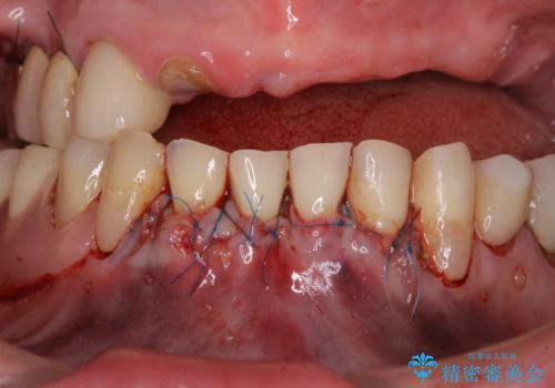 前歯の歯肉退縮　歯肉移植による根面被覆の治療後