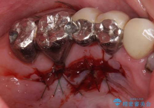前歯の歯肉退縮　歯肉移植による根面被覆の治療中