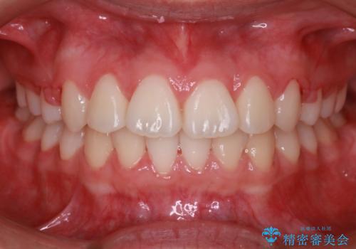 笑顔がきれいになった。抜歯矯正(審美装置)の症例 治療後