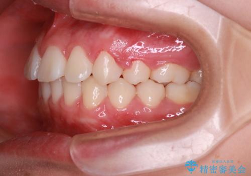 笑顔がきれいになった。抜歯矯正(審美装置)の治療後