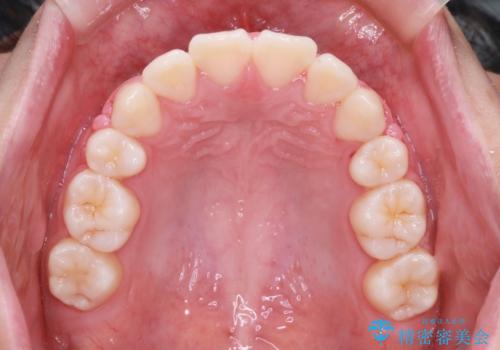 笑顔がきれいになった。抜歯矯正(審美装置)の治療後