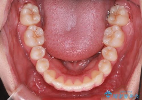 笑顔がきれいになった。抜歯矯正(審美装置)の治療後