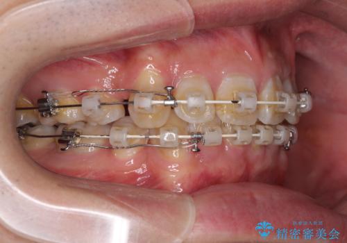 口元の突出感と叢生 ワイヤー装置による抜歯矯正の治療中