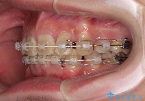 口元の突出感と叢生 ワイヤー装置による抜歯矯正の治療中