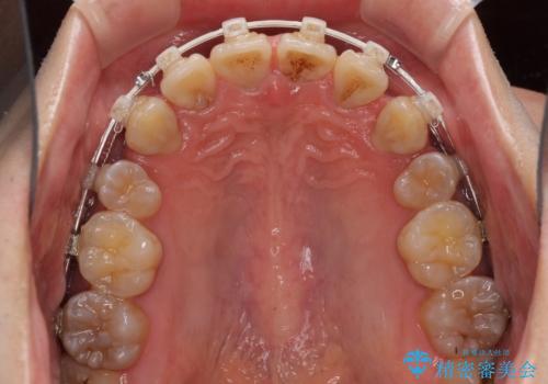 口元の突出感と叢生　ワイヤー装置による抜歯矯正の治療中