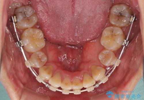 口元の突出感と叢生　ワイヤー装置による抜歯矯正の治療中