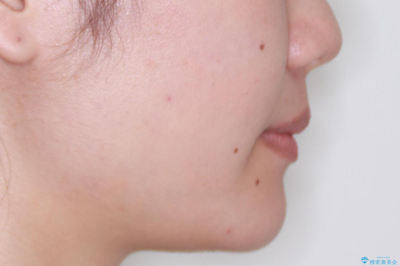 笑顔がきれいになった。抜歯矯正(審美装置)の治療後(顔貌)