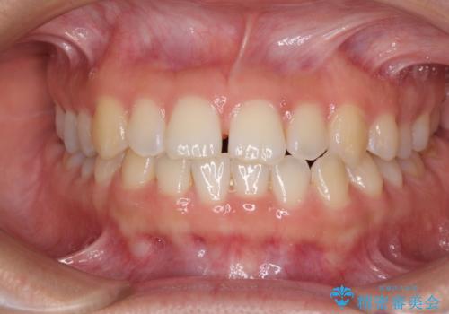 前歯の隙間を閉じたい　短期間でのワイヤー矯正の症例 治療前