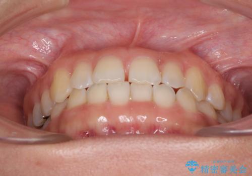 前歯の隙間を閉じたい　短期間でのワイヤー矯正の治療前