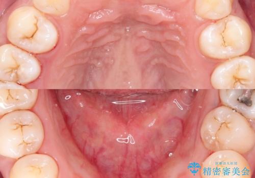 喫煙による歯にこびりついたステインの除去の症例 治療後
