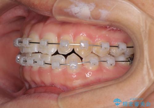 前歯の隙間を閉じたい　短期間でのワイヤー矯正の治療中