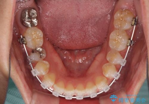 前歯の隙間を閉じたい　短期間でのワイヤー矯正の治療中