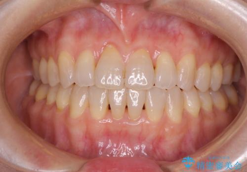 前歯の叢生と切端咬合　インビザラインによる矯正治療