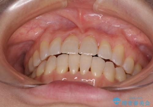 前歯の叢生と切端咬合　インビザラインによる矯正治療の治療後