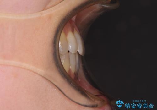 前歯の叢生と切端咬合 インビザラインによる矯正治療の治療後