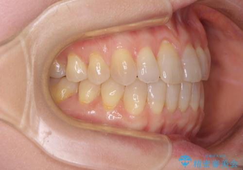 前歯の叢生と切端咬合 インビザラインによる矯正治療の治療後