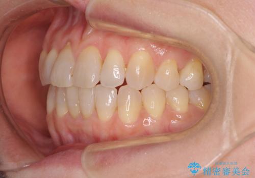 前歯の叢生と切端咬合 インビザラインによる矯正治療の治療後