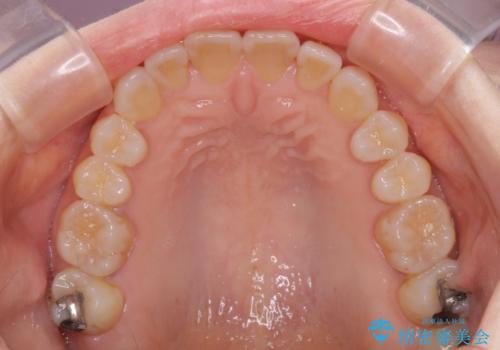 前歯の叢生と切端咬合 インビザラインによる矯正治療の治療後