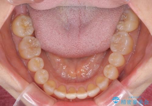 前歯の叢生と切端咬合 インビザラインによる矯正治療の治療後