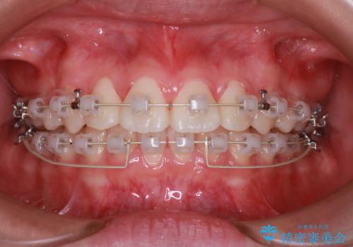 笑顔がきれいになった。抜歯矯正(審美装置)