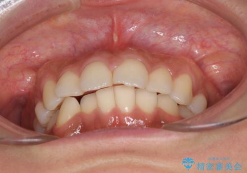 抜歯矯正の後戻り インビザラインによる再矯正治療の治療前