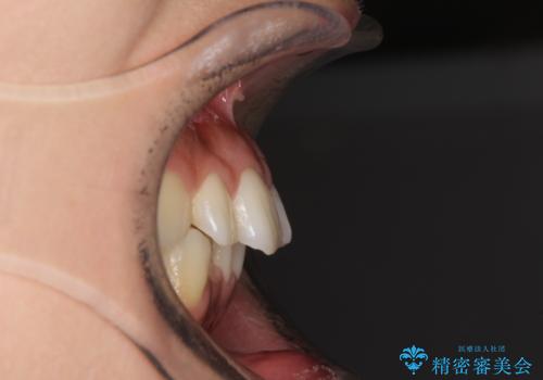 抜歯矯正の後戻り インビザラインによる再矯正治療の治療前