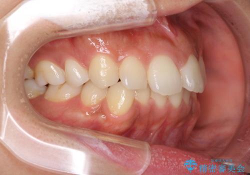 抜歯矯正の後戻り インビザラインによる再矯正治療の治療前