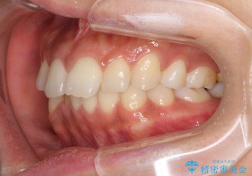 抜歯矯正の後戻り インビザラインによる再矯正治療の治療前