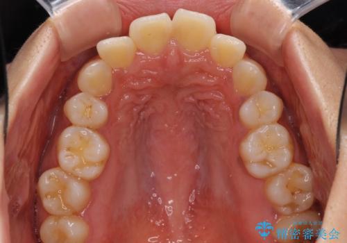 抜歯矯正の後戻り インビザラインによる再矯正治療の治療前