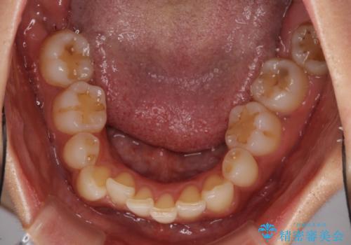 抜歯矯正の後戻り インビザラインによる再矯正治療の治療前