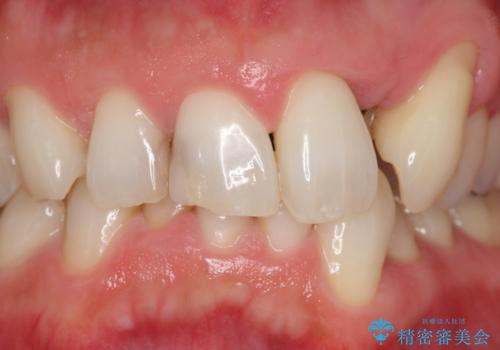 歯並びをきれいにしたい、歯を真っ白にしたい 40代男性の治療前