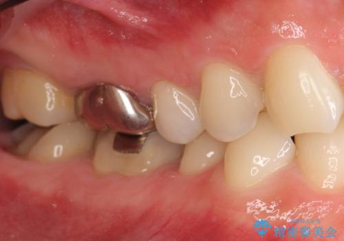 歯並びをきれいにしたい、歯を真っ白にしたい 40代男性の治療前