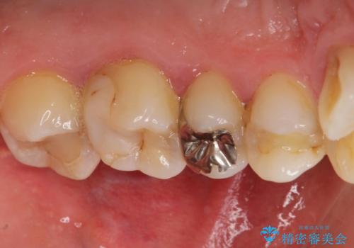 歯並びをきれいにしたい、歯を真っ白にしたい 40代男性の治療前