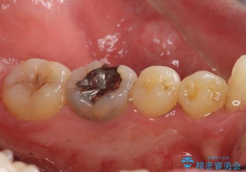 歯並びをきれいにしたい、歯を真っ白にしたい 40代男性の治療前