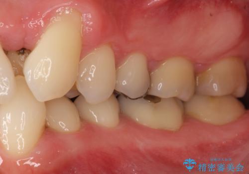 歯並びをきれいにしたい、歯を真っ白にしたい 40代男性の治療前