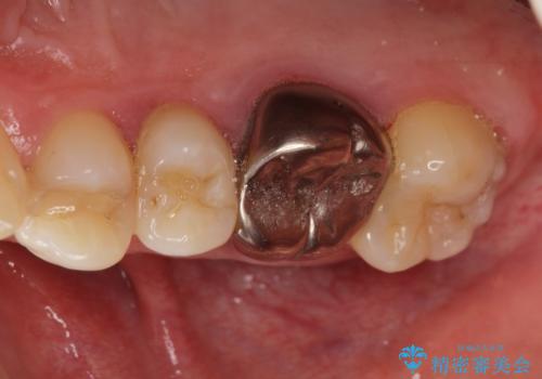 歯並びをきれいにしたい、歯を真っ白にしたい 40代男性の治療前