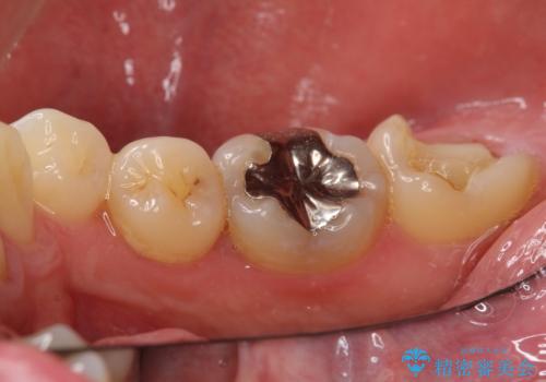 歯並びをきれいにしたい、歯を真っ白にしたい 40代男性の治療前