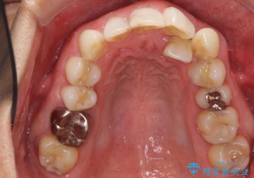 歯並びをきれいにしたい、歯を真っ白にしたい 40代男性の治療前